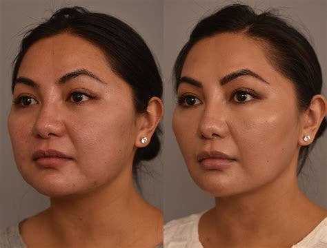 Facial liposuction kelowna  For the best chance